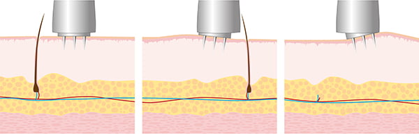 MESO MICRONEEDLING TIPS 4