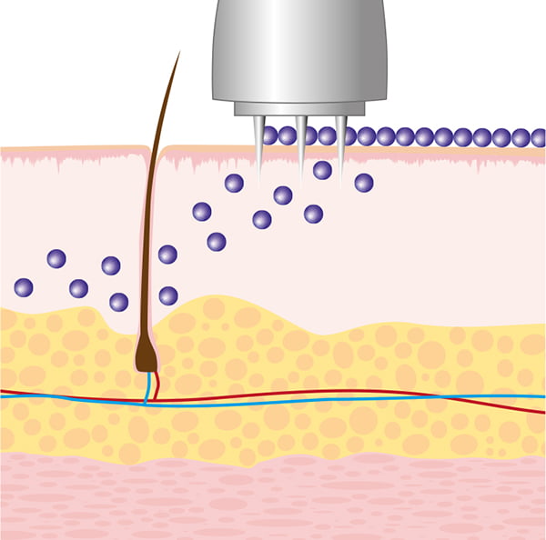 MESO MICRONEEDLING TIPS 3